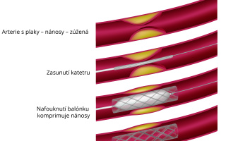 Angioplastika