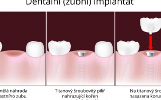 Dentální implantát