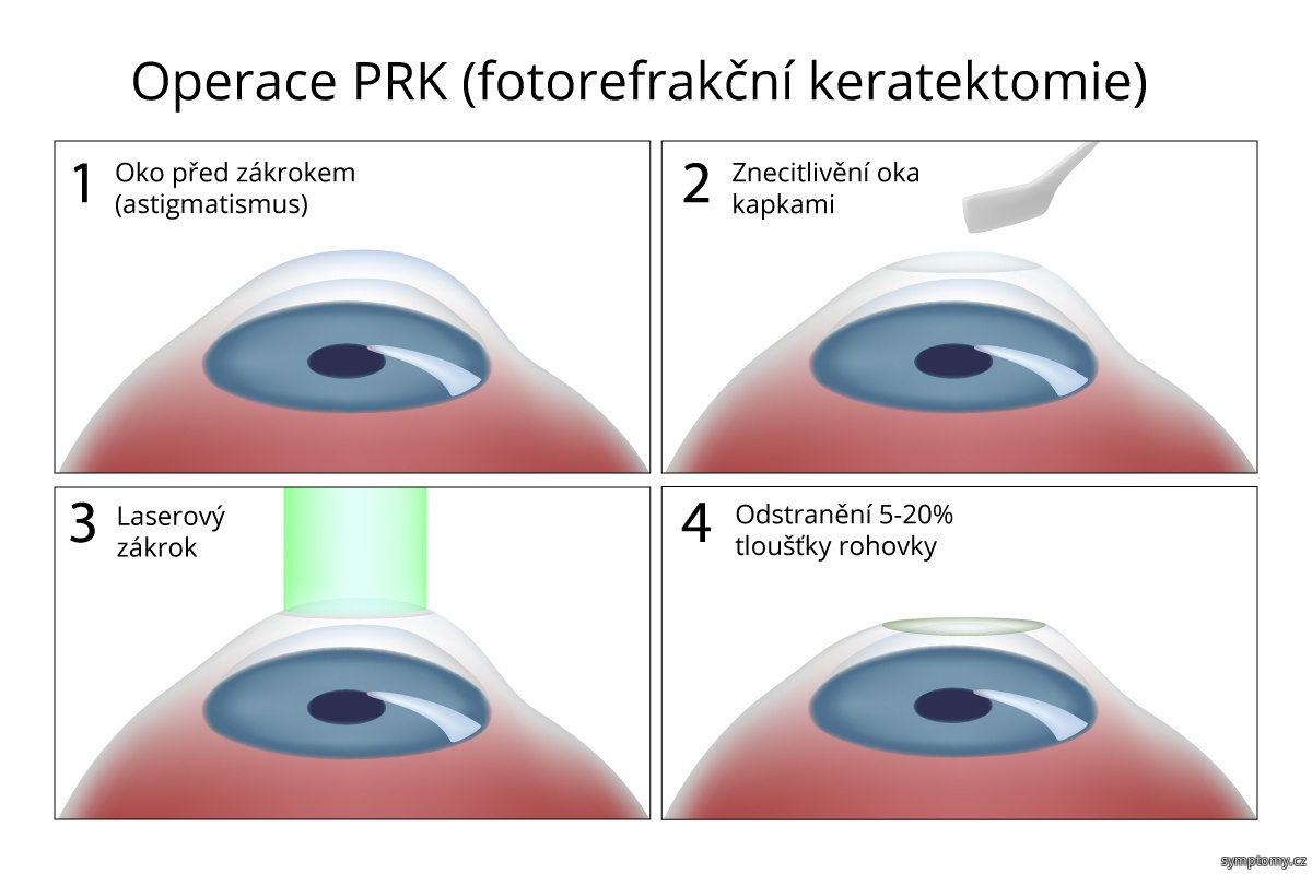operace PRK (fotorefrakční keratektomie)