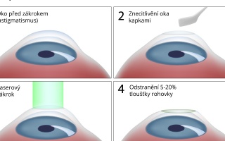 Fotorefrakční keratektomie