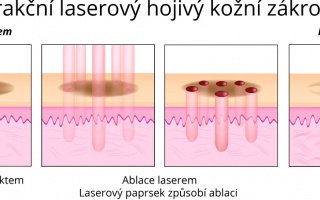 Frakční laserový hojivý kožní zákrok