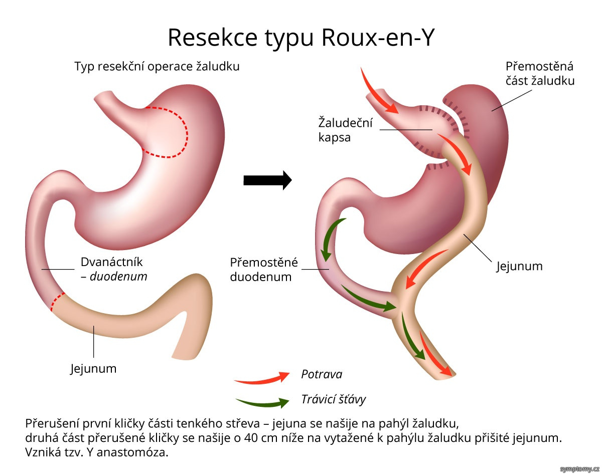 Co jíst po bypassu?