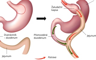 Gastrický bypass ROUX-en-Y spojka