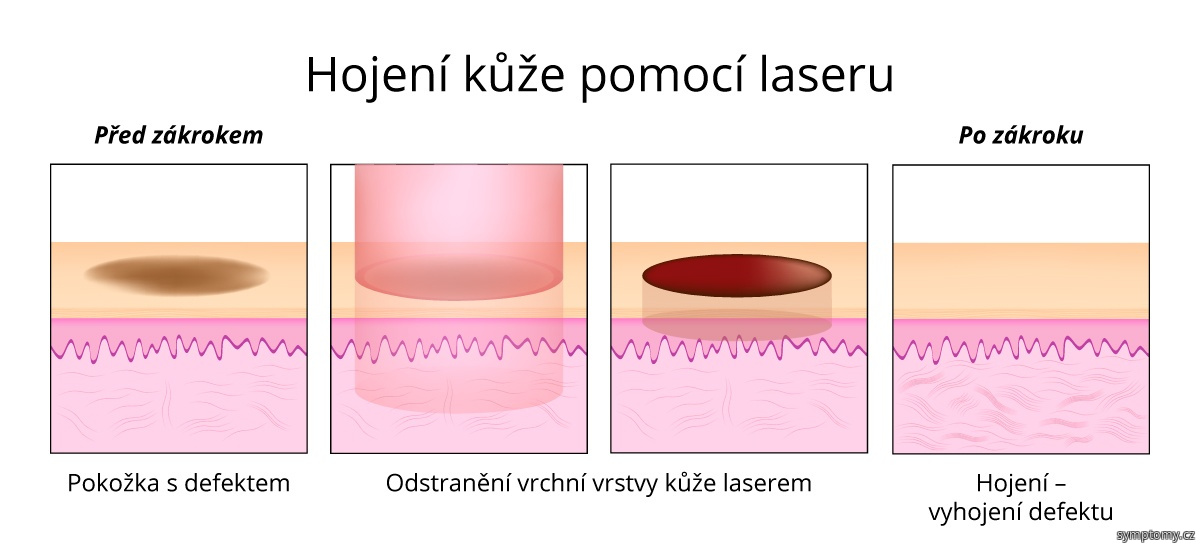 Hojení kůže pomocí laseru