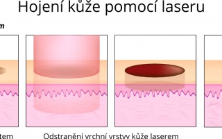 Hojení kůže pomocí laseru