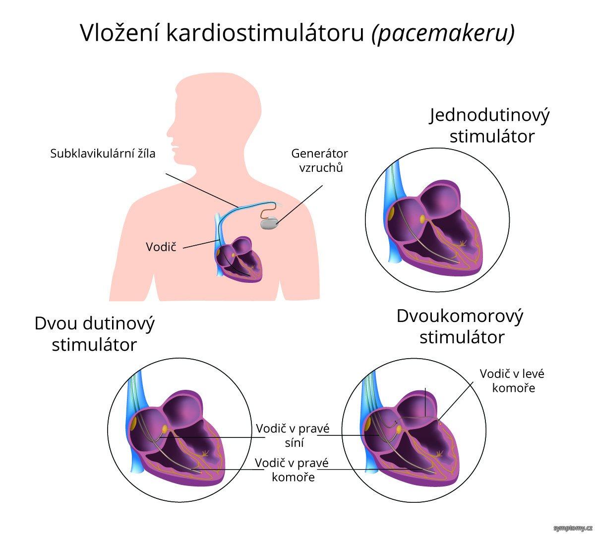 Vložení kardiostimulátoru (pacemakeru).