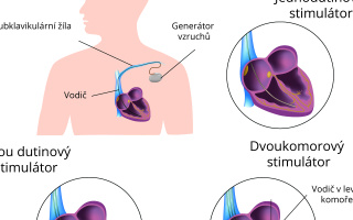 Implantace kardiostimulátoru 