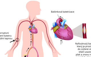 Koronární angioplastika