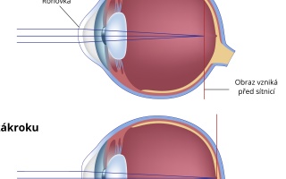 Laserová operace očí – LASIK