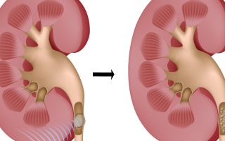 Léčba ledvinových kamenů rázovou vlnou