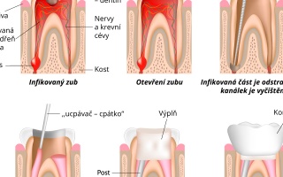 Léčba zubního kanálku