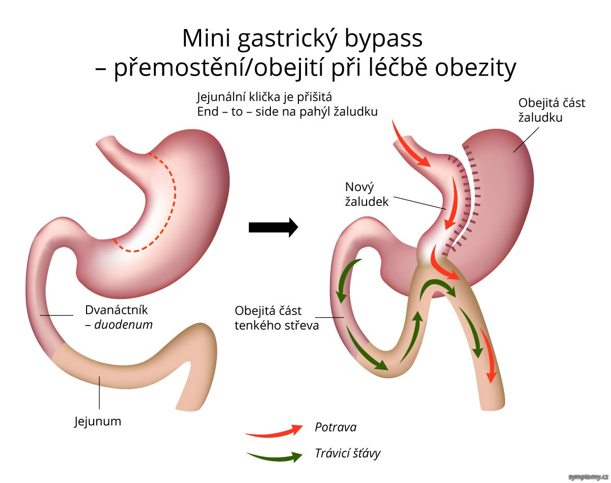 Mini gastrický bypass – přemostění obejití při léčbě obezity