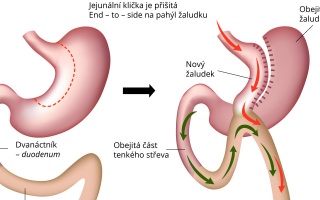 Mini gastrický bypass