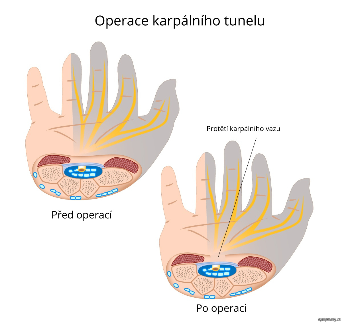 Operace karpalniho tunelu - protětí karpálního vazu