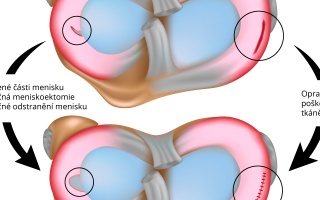 Operace - natržený meniskus