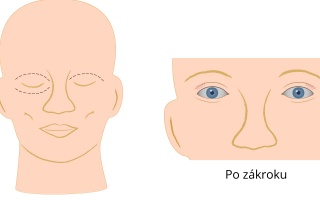 Operace očních víček