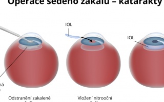 Operace šedého zákalu - katarakta