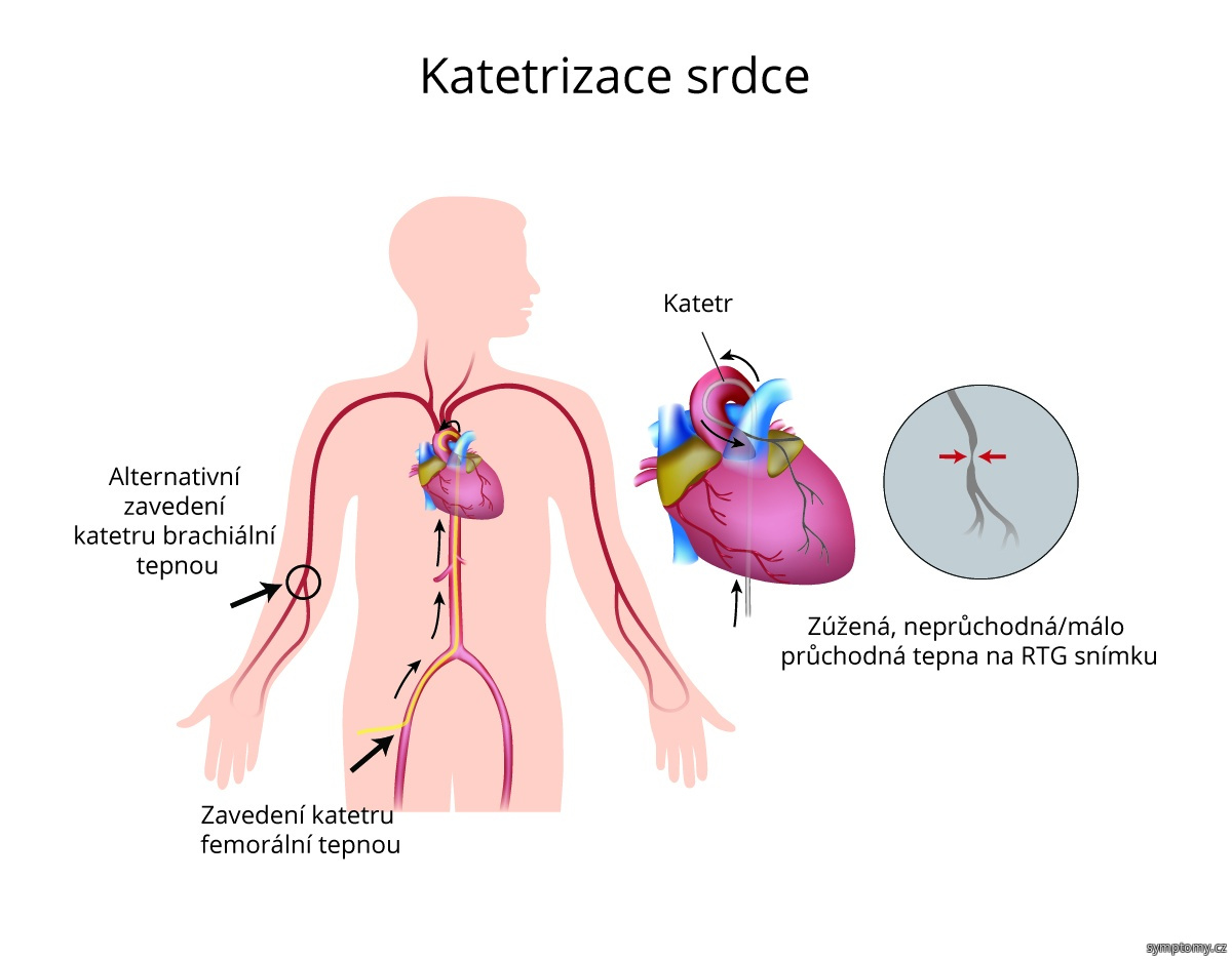 Kdy se provádí katetrizace?