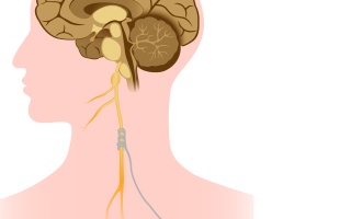 Stimulace X. hlavového nervu