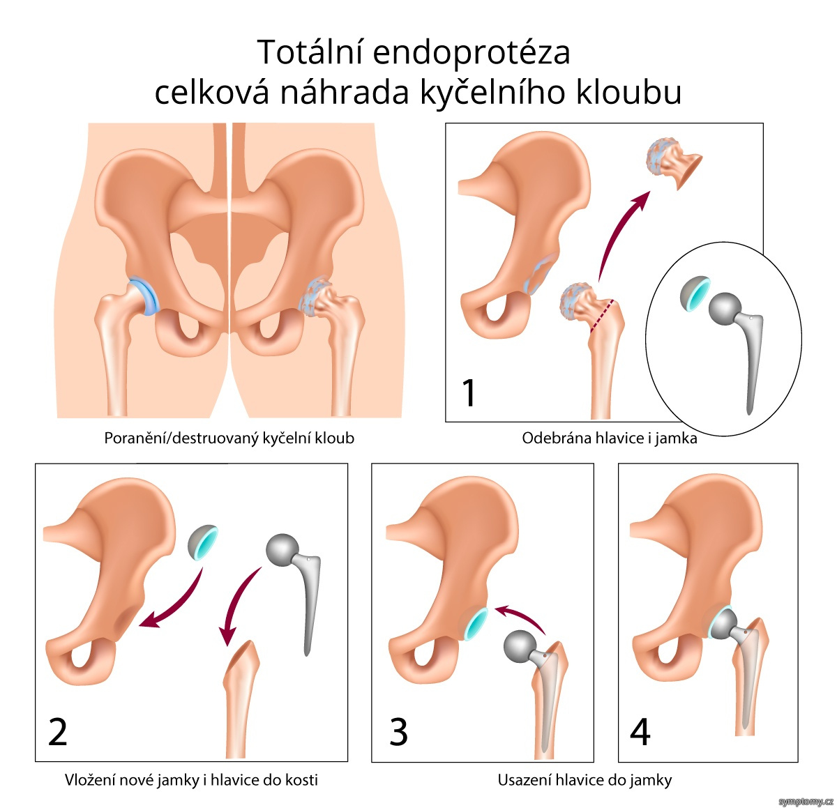 Totální endoprotéza – celková náhrada kyčelního kloubu
