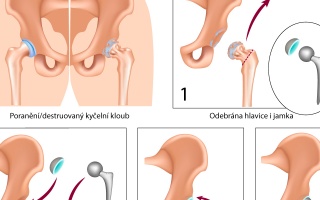 Totální endoprotéza – náhrada kyčelního kloubu