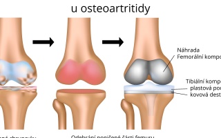 Totální náhrada kolenního kloubu