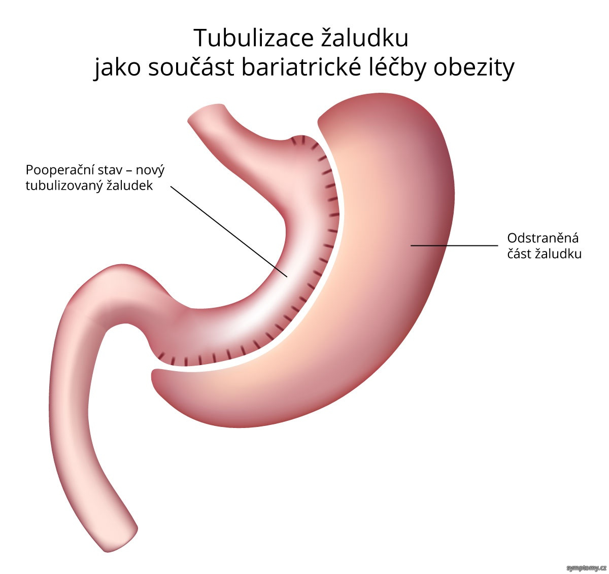 Tubulizace žaludku jako součást bariatrické léčby obezity