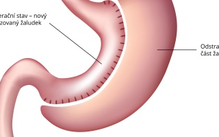 Tubulizace žaludku