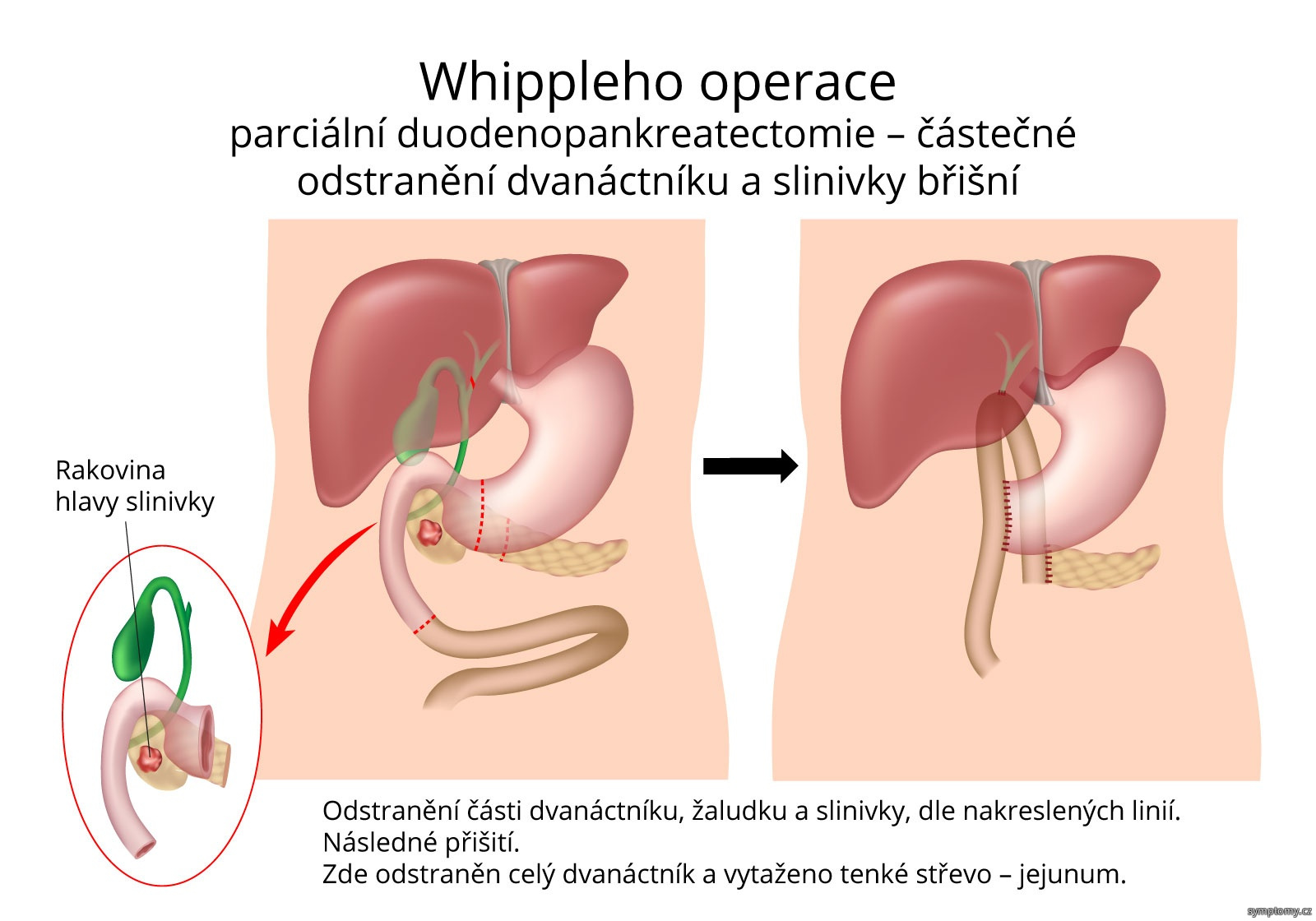 Whippleho operace - částečné odstranění dvanáctníku a slinivky břišní